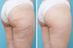 Smart Massager Anti-Cellulite | Eliscence